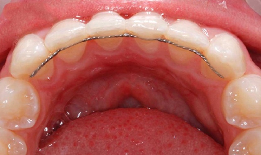 Đeo hàm duy trì sau niềng theo chỉ định của bác sĩ