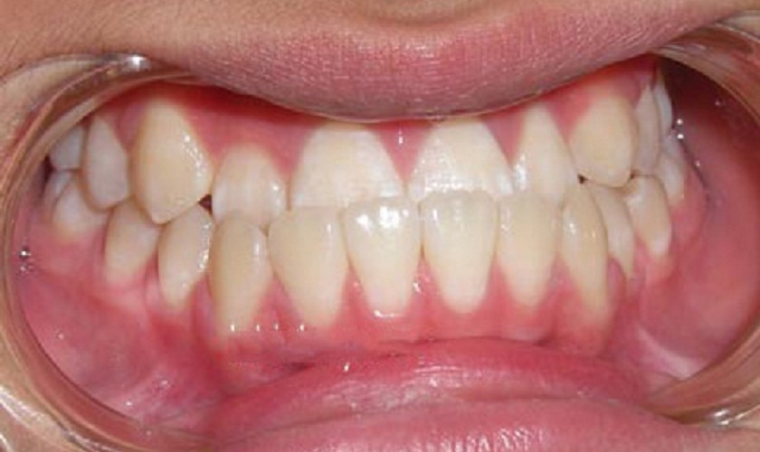 Tình trạng răng móm gây mất thẩm mỹ nghiêm trọng