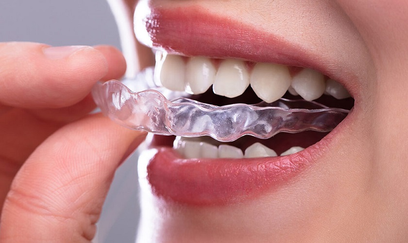 Niềng răng invisalign có đau không?