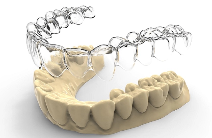 Vì sao chi phí niềng răng invisalign cao hơn những phương pháp khác?