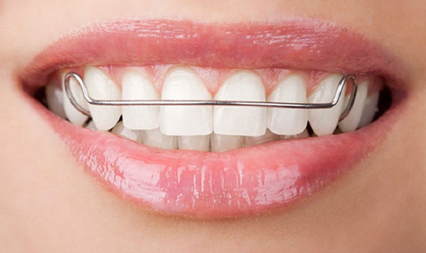 Đeo hàm duy trì để cải thiện lệch mặt mức độ nhẹ