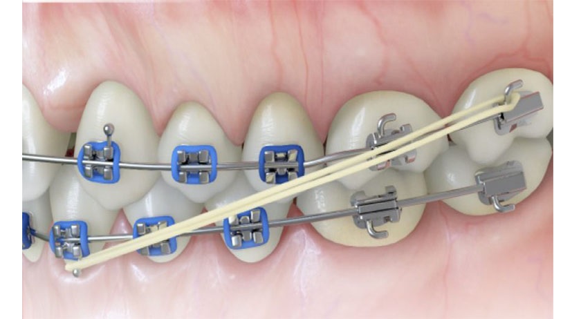 Những điều nên tránh khi đeo thun niềng răng