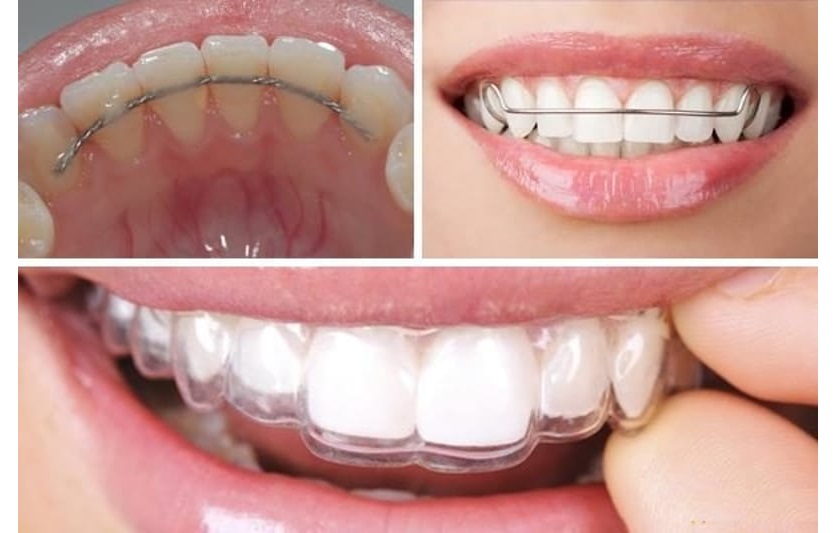 Vì sao nên đeo hàm duy trì?