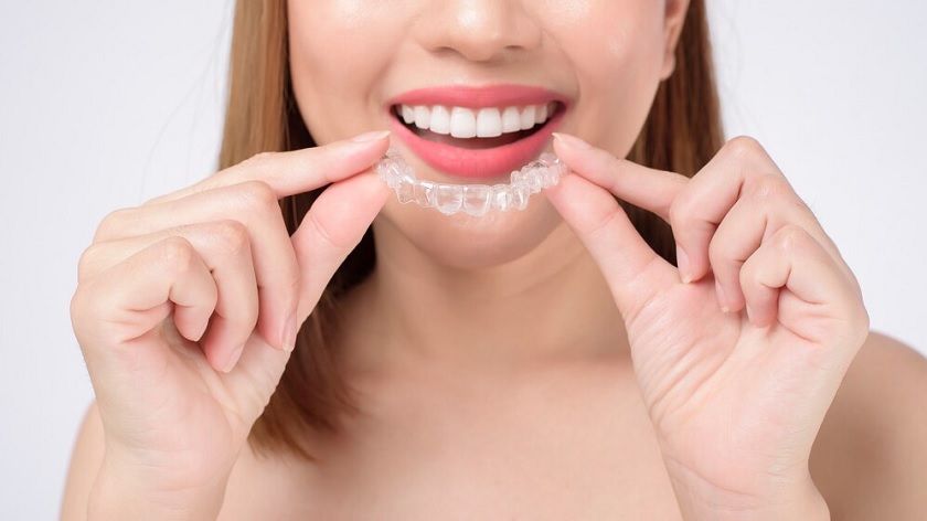 Khay niềng invisalign đều được đặt hàng và chế tác tại nước ngoài