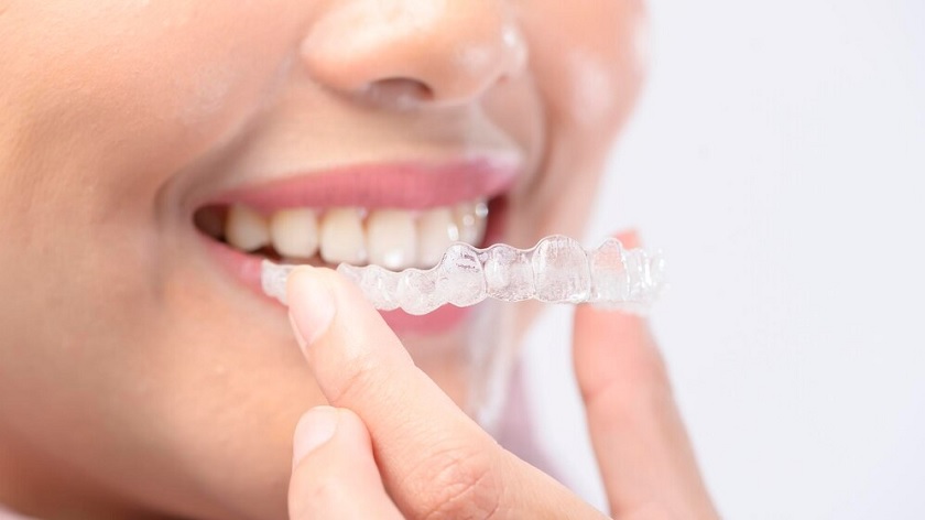 Niềng răng trong suốt invisalign có độ tương thích và tính thẩm mỹ cao