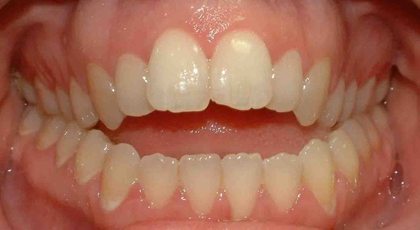 Khớp cắn bị hở