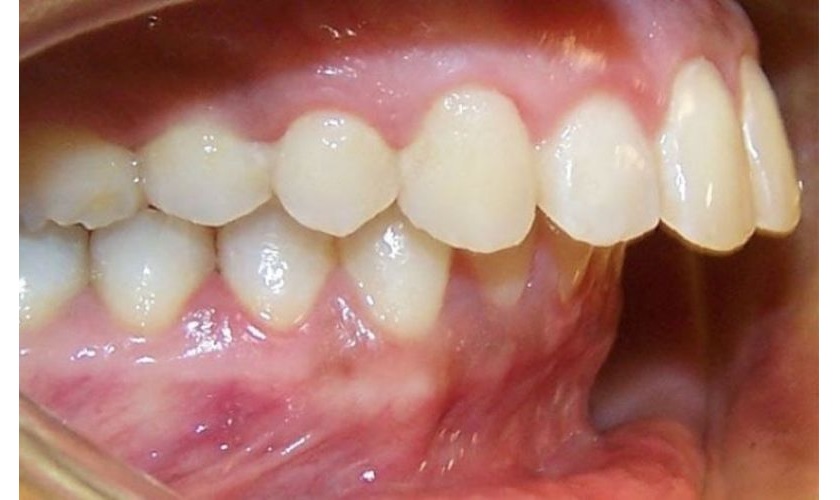 Hình ảnh răng hô nặng khiến khách hàng không thể khép miệng hoàn toàn