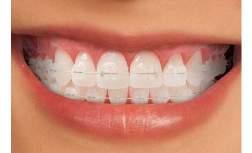 Niềng răng mắc cài sứ