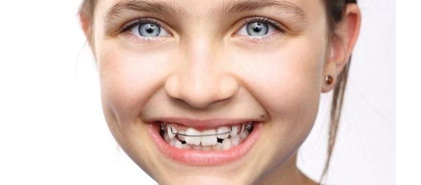 12-16 tuổi là giai đoạn giúp quá trình niềng răng được hoàn thành nhanh chóng nhất