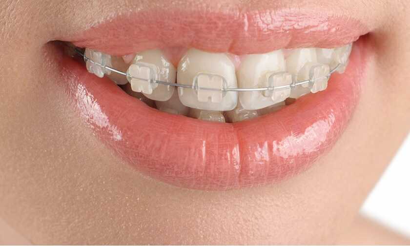 Niềng răng mắc cài sứ có tính thẩm mỹ cao