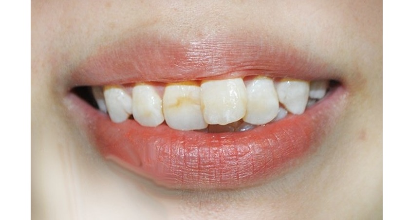 Răng cửa bị lệch