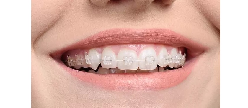 Niềng răng mắc cài sứ có chi phí nhỉnh hơn so với niềng răng mắc cài kim loại