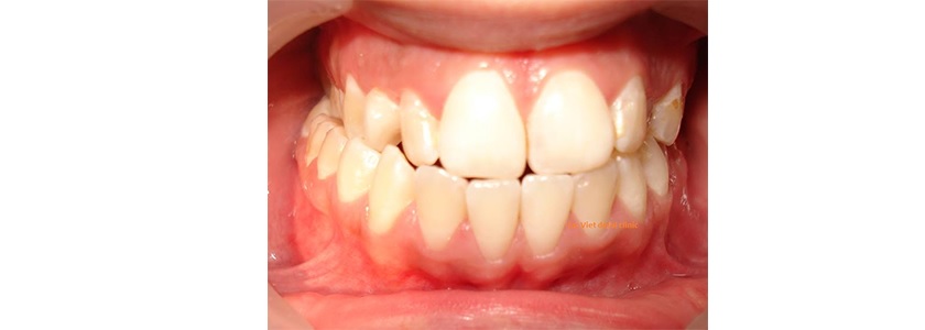 Hình ảnh khớp cắn chéo