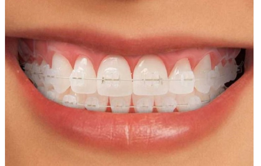 Niềng răng mắc cài sứ