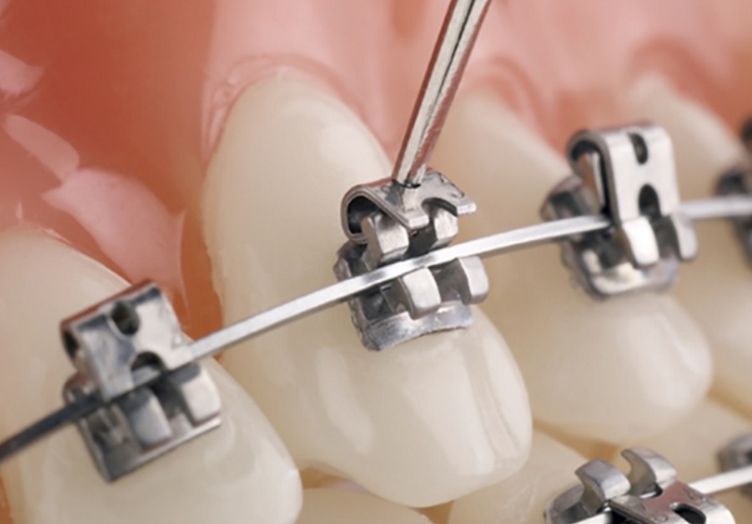 Niềng răng mắc cài tự đóng