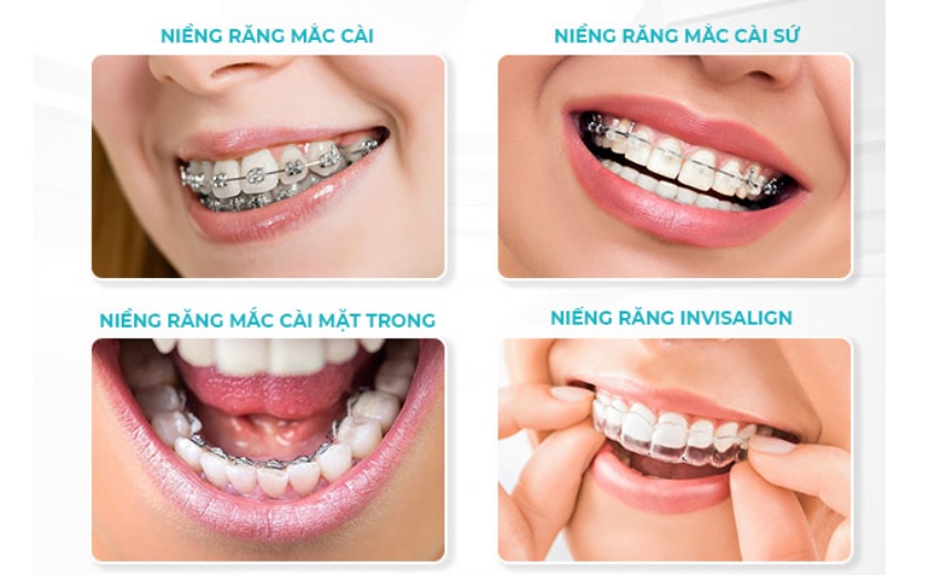 Mỗi phương pháp chỉnh nha sẽ có mức chi phí khác nhau