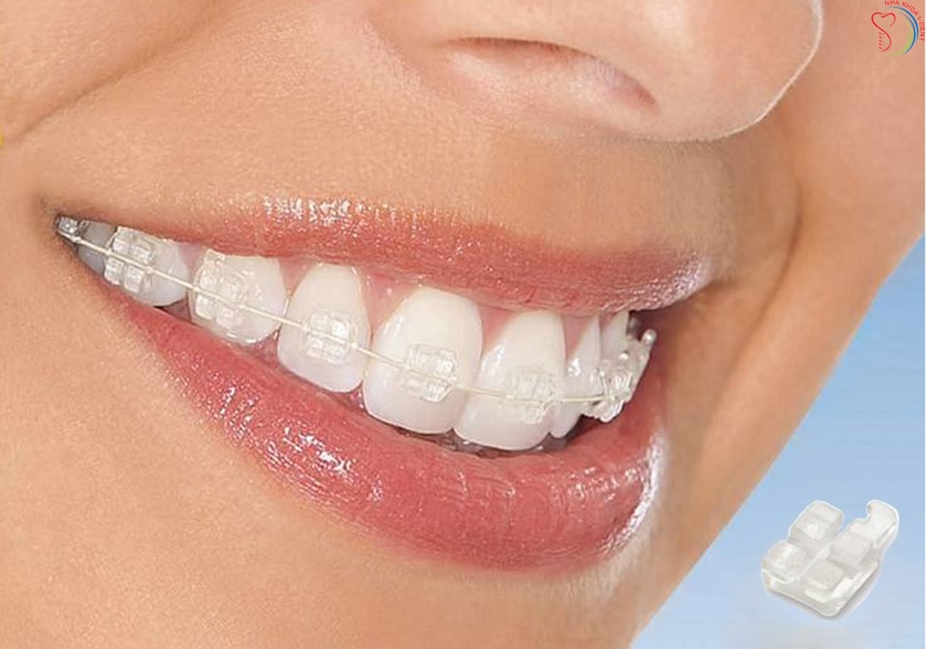 Niềng răng hô với mắc cài sứ