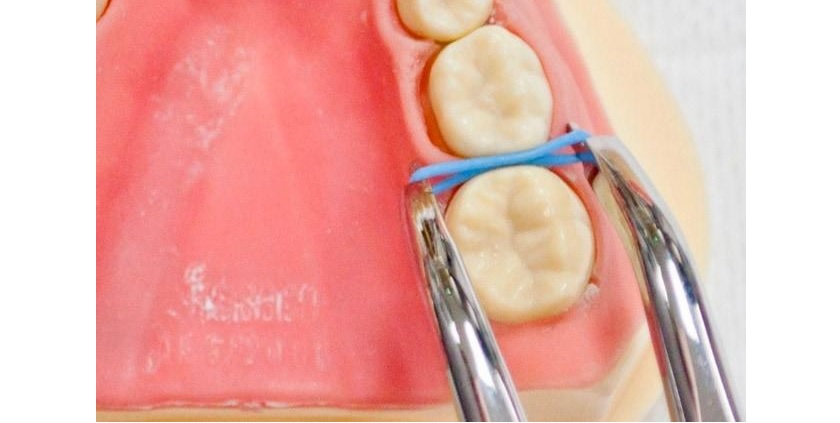 Đặt thun tách kẽ trước khi chỉnh nha