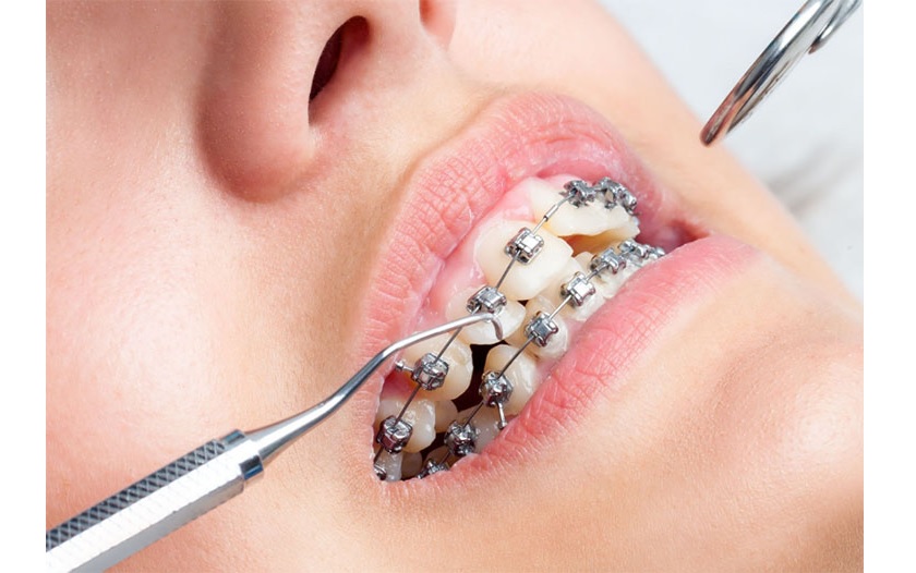 Quá trình siết răng sẽ diễn ra 1 lần/tháng