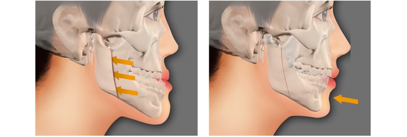 Răng bị khớp cắn ngược do cả răng lẫn xương thì cần kết hợp cả phẫu thuật chỉnh hàm móm và niềng răng chỉnh nha