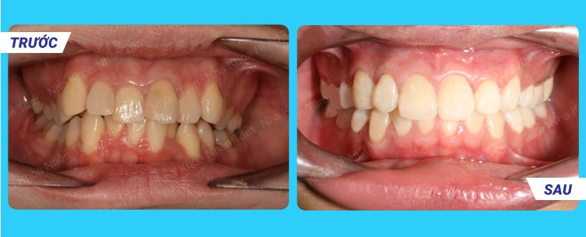 Nha Khoa Nhân Tâm – Đơn vị niềng răng uy tín số 1 hiện nay