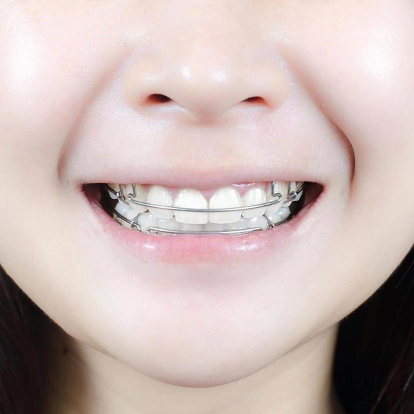 Thời gian đeo hàm duy trì sẽ tuỳ thuộc vào tình trạng răng sau niềng của bạn