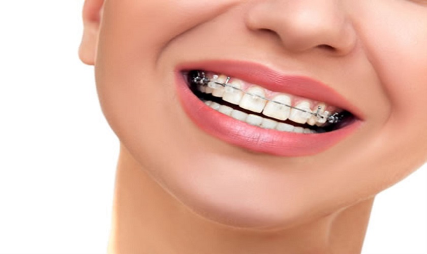 Niềng răng 1 hàm có được không? Áp dụng với trường hợp nào?