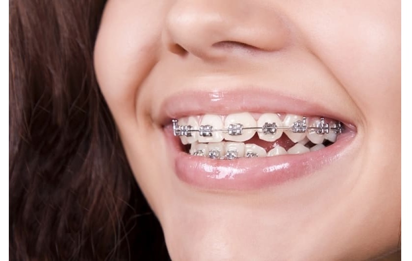 Niềng răng 2 hàm sẽ giúp đưa răng về đúng vị trí chuẩn một cách nhanh chóng