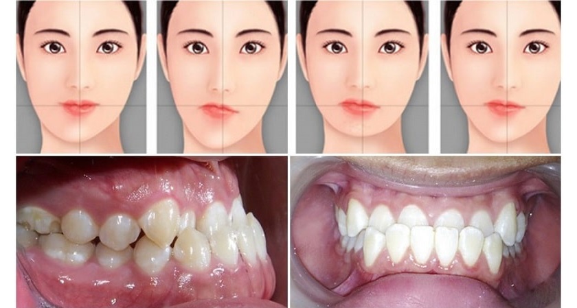Sai lệch khớp cắn là một trong những rủi ro có thể gặp khi niềng răng