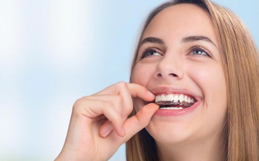 Những thắc mắc thường thấy về niềng răng vô hình Invisalign
