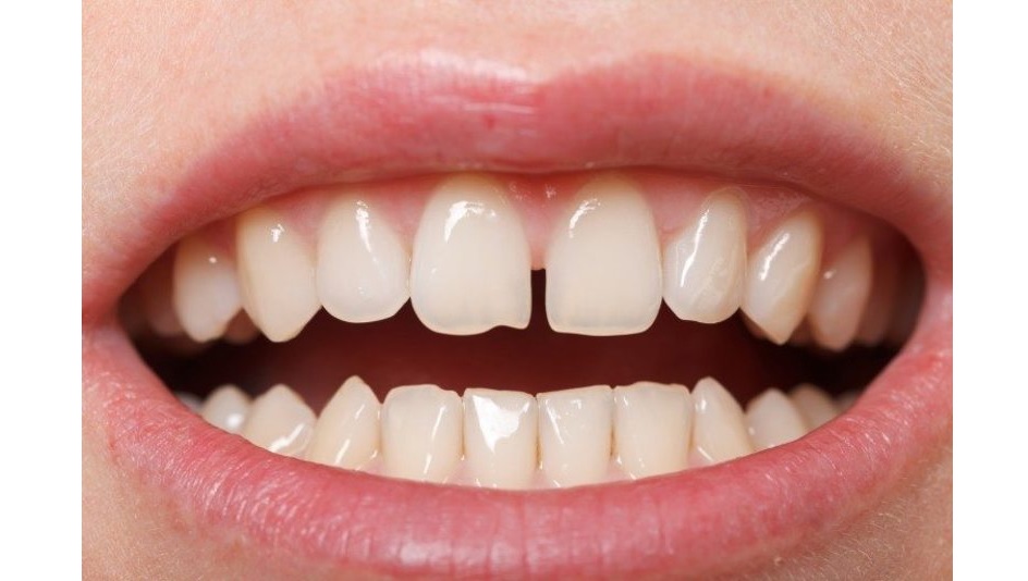 Răng thưa, hở kẽ