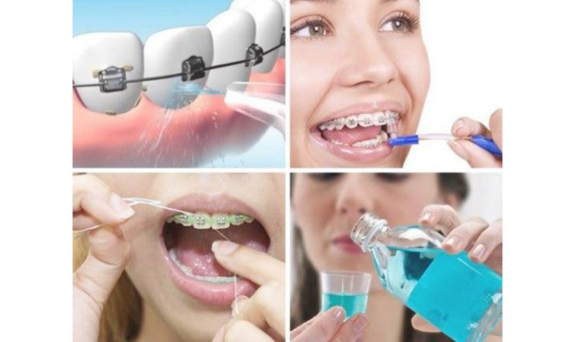 Vệ sinh răng niềng thật kỹ để phòng ngừa hôi miện