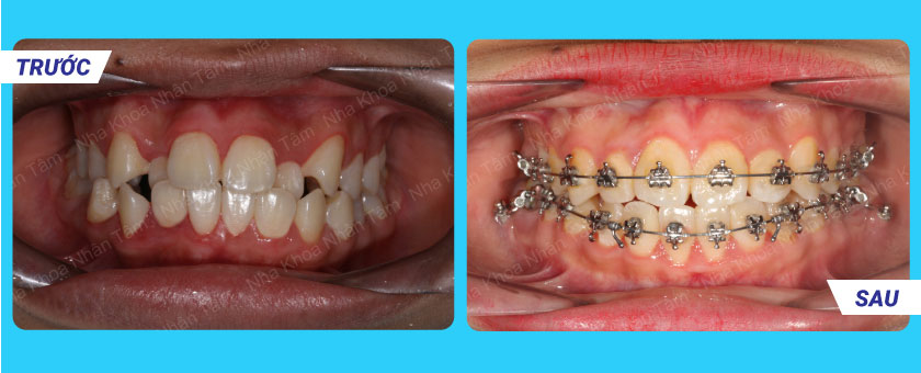 Khách hàng niềng răng tại Nha khoa Nhân Tâm