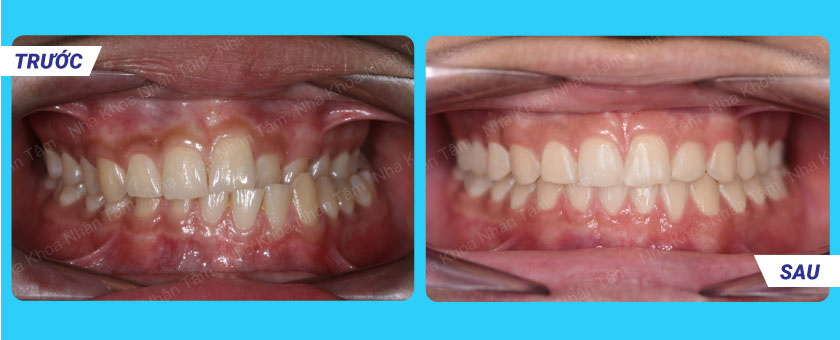 Khách hàng niềng răng tại Nha khoa Nhân Tâm