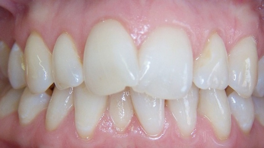 Tình trạng răng mình ảnh hưởng đến chi phí niềng