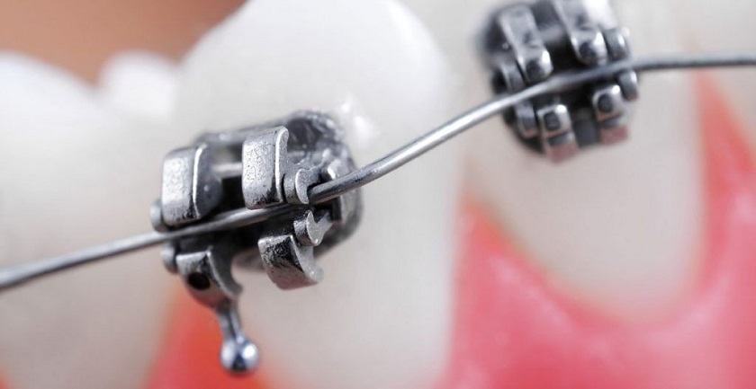 Nên đến ngay nha khoa khi gặp sự cố tuột dây cung