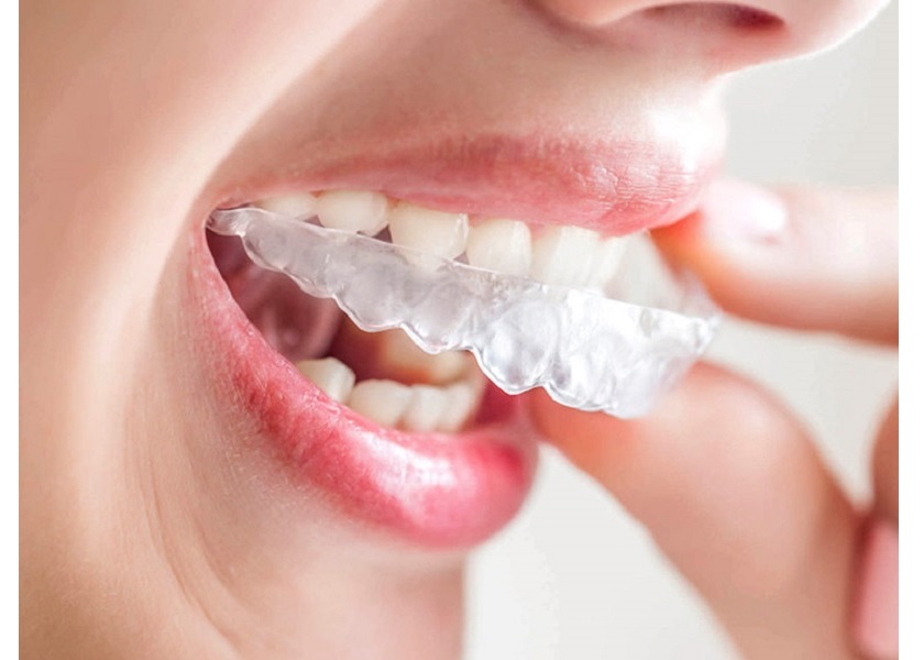 Niềng răng vô hình Invisalign