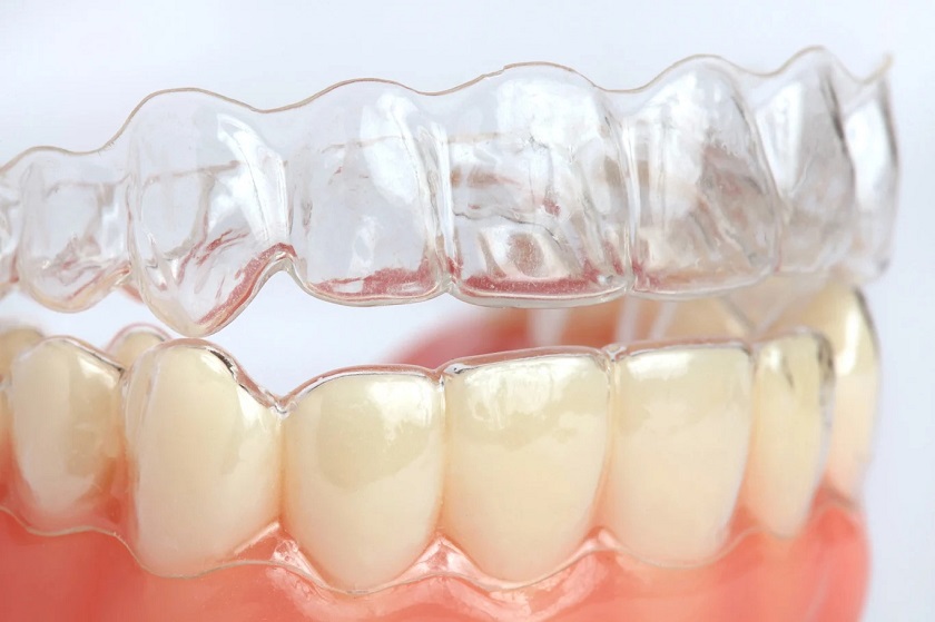 Invisalign G5 giải pháp điều trị khớp cắn sâu hiệu quả