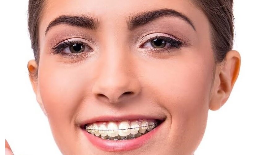Những điều cần biết về niềng răng sứ