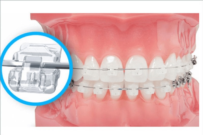 Niềng răng mắc cài sứ mang lại thẩm mỹ cao