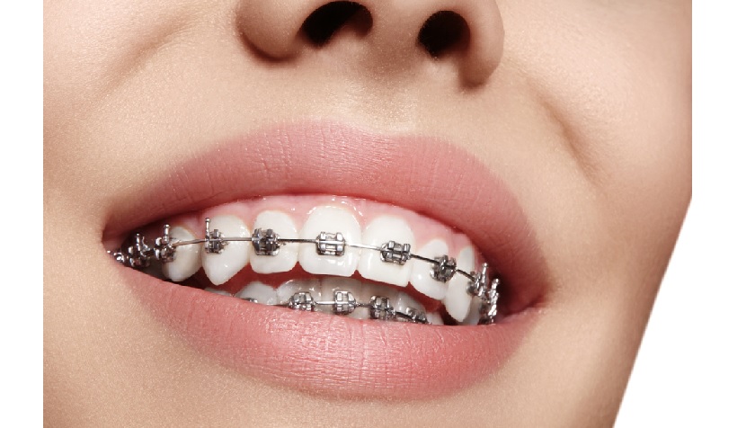 Niềng răng mắc cài kim loại