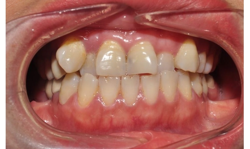 Răng khấp khểnh, chen chúc là một trong những trường hợp nên tiến hành niềng răng Răng khấp khểnh, chen chúc là một trong những trường hợp nên tiến hành niềng răng