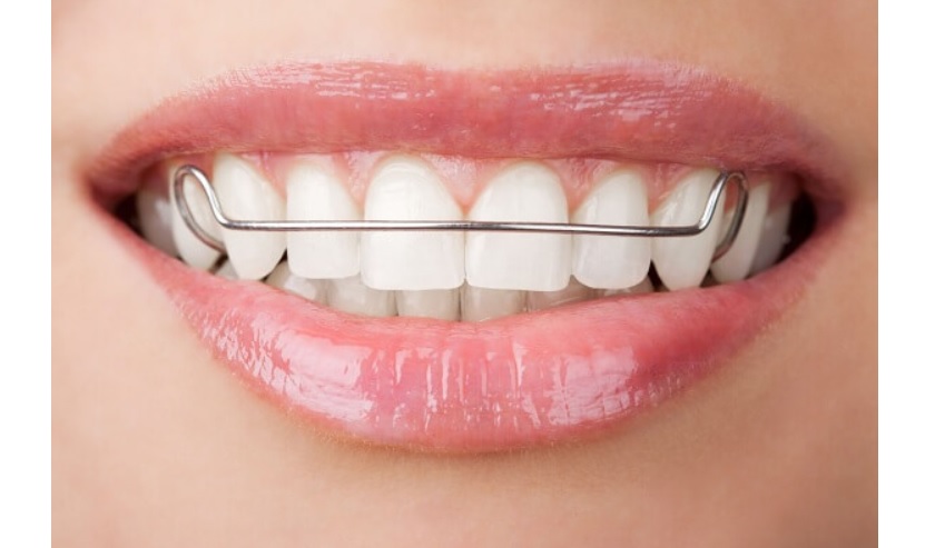 Cần vệ sinh, lau chùi hàm duy trì cẩn thận, tránh để vi khuẩn có cơ hội tấn công khoang miệng gây viêm nhiễm