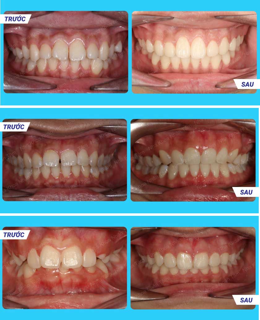 Hình ảnh khách hàng niềng răng tại Nha khoa Nhân Tâm