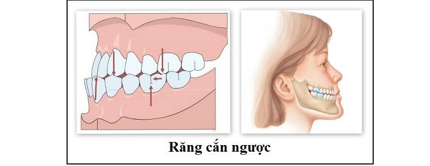 Mô phỏng hình ảnh khớp cắn ngược