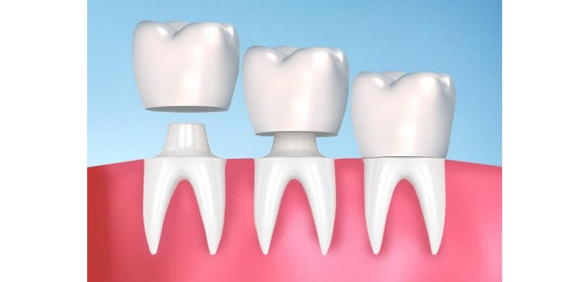 Phục hình răng sứ khớp cắn ngược