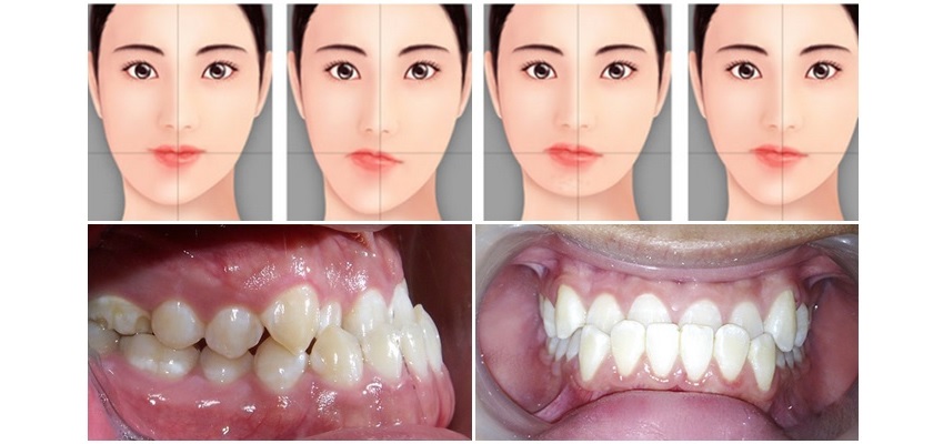 Khớp cắn chéo gây mất đối xứng giữa 2 hàm răng