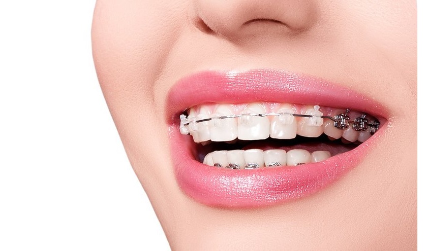 Niềng răng chỉnh nha điều chỉnh khớp cắn chéo