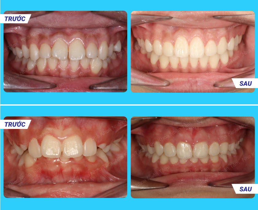 Hình ảnh khách hàng niềng răng tại Nha khoa Nhân Tâm