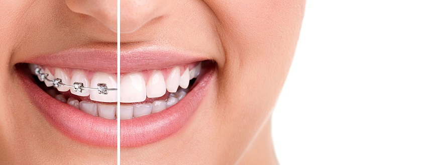 Niềng răng giúp bạn tự tin hơn khi giao tiếp